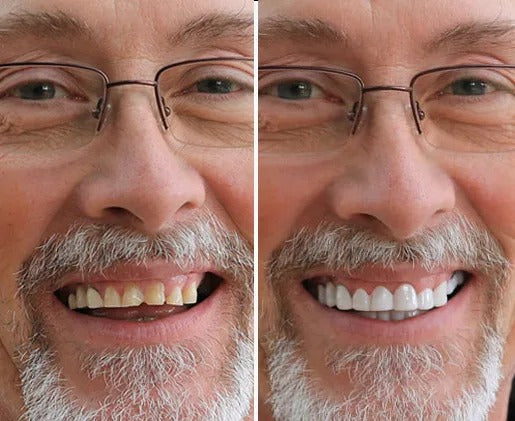 Finestis™ Snap-On Veneers