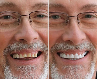 Finestis™ Snap-On Veneers